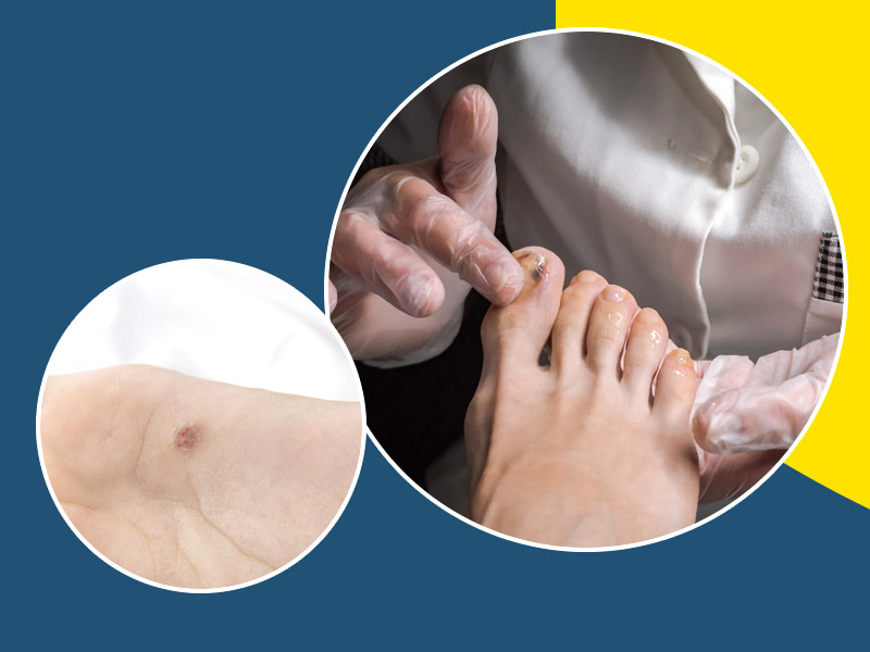 पैर में मेलेनोमा (स्किन कैंसर) होने पर दिखते हैं ये 6 संकेत, जानें कैसे करें बचाव  